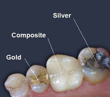 Types of Fillings