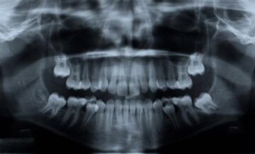 Digital Panoramic X-Rays