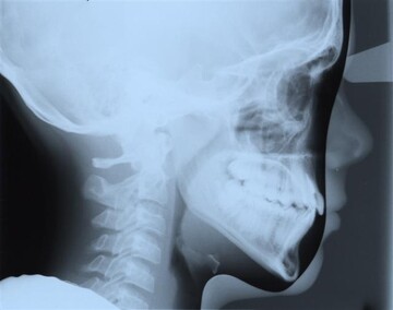 Cephalometric X-Rays